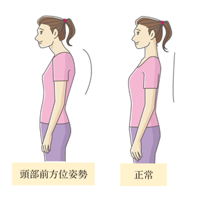 頭部前方位姿勢‗改善‗予防